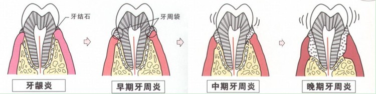 牙周炎的治疗