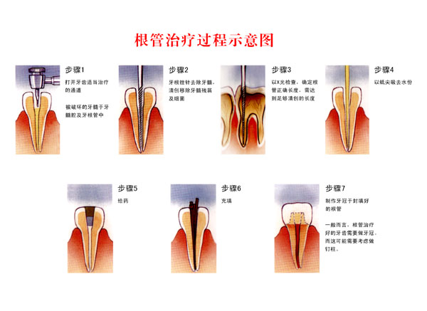 牙周疾病选择根管治疗