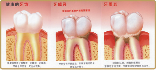 牙周炎有哪些危害