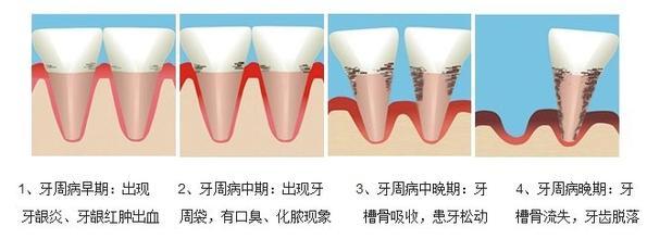 牙龈萎缩怎么治疗