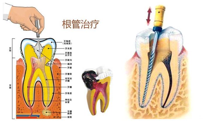根管治疗步骤