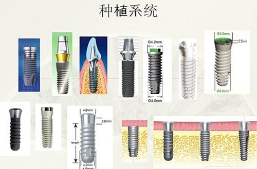 种植牙的品牌